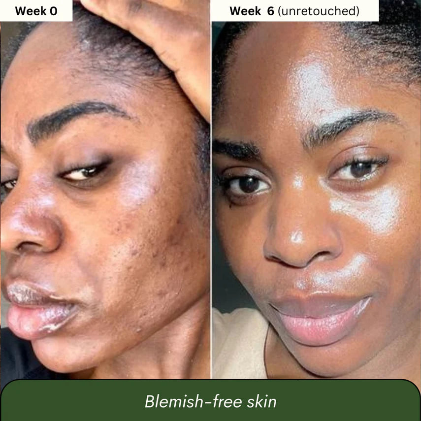 Jabón de Cúrcuma y  Ácido kójico x3 unidades (2 meses)