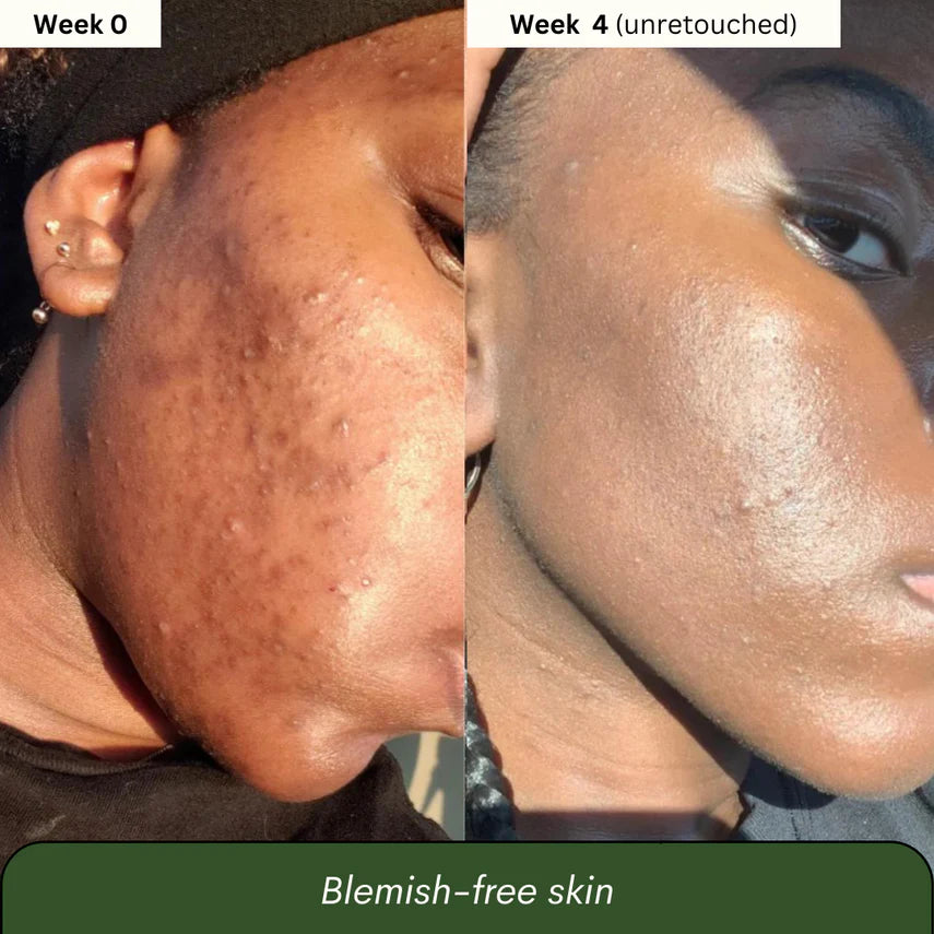 Jabón de Cúrcuma y  Ácido kójico x3 unidades (2 meses)