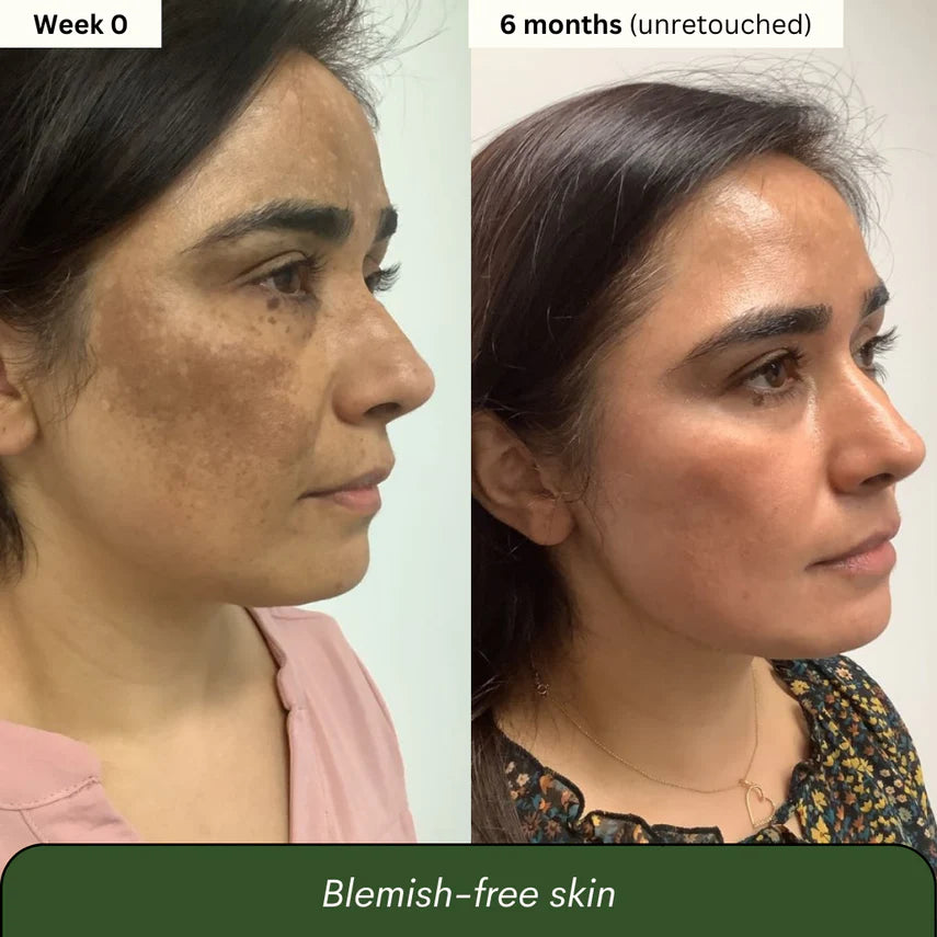 Jabón de Cúrcuma y  Ácido kójico x3 unidades (2 meses)